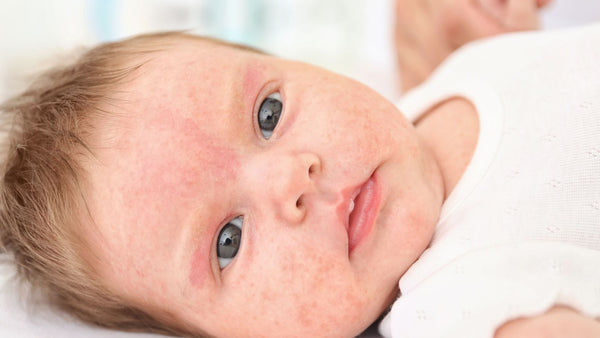 Crema piel atópica bebé: causas, síntomas y tratamientos